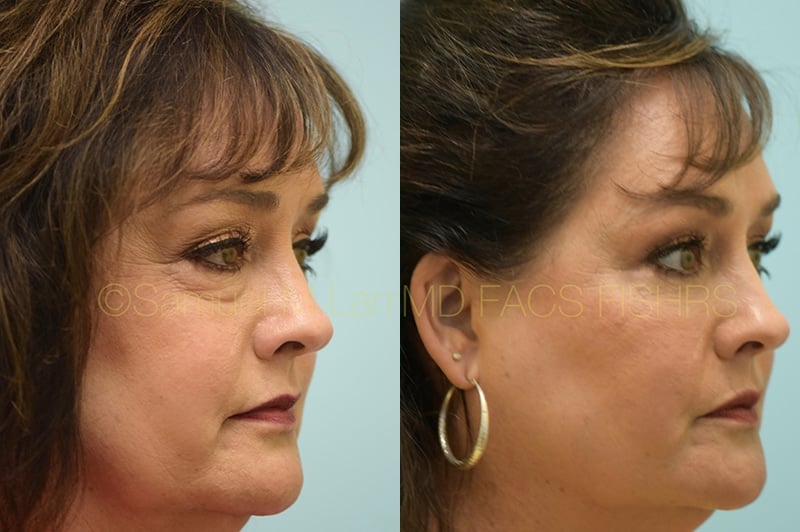 Eyelid Rejuvenation, Fat Grafting Eyelid Rejuvenation, Fat Grafting