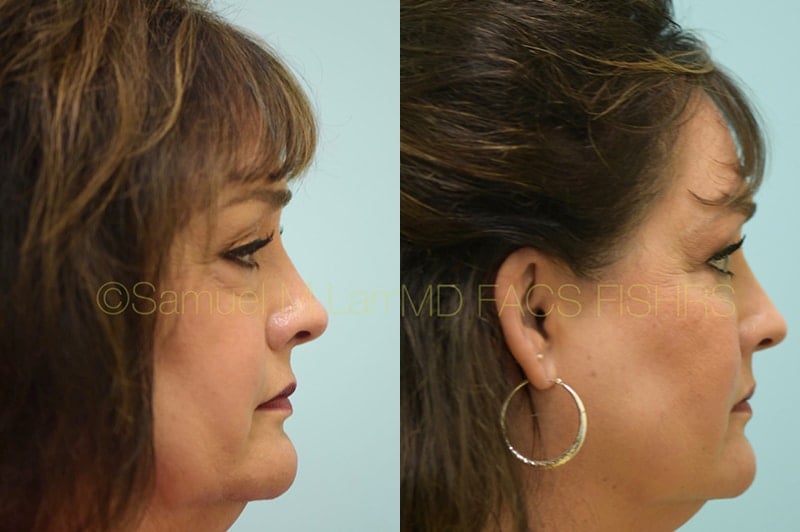 Eyelid Rejuvenation, Fat Grafting Eyelid Rejuvenation, Fat Grafting