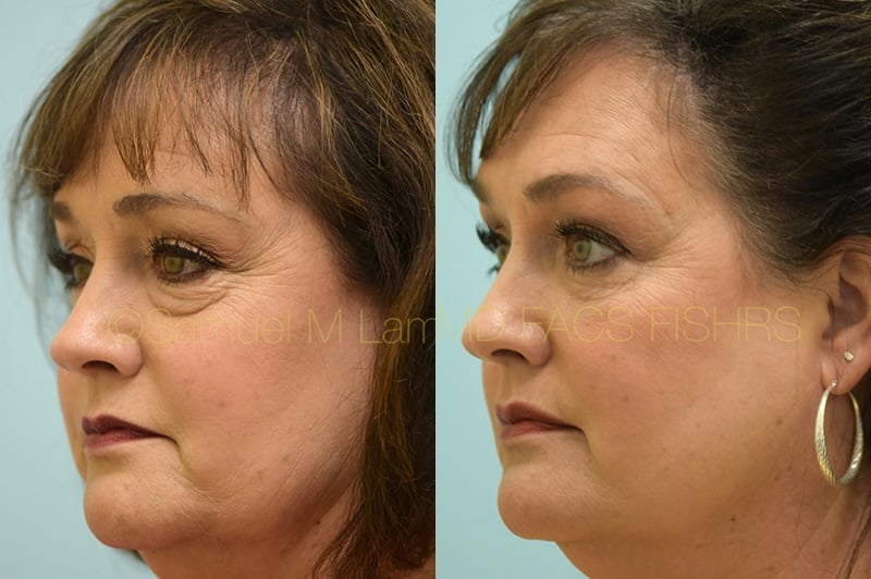 Eyelid Rejuvenation, Fat Grafting Eyelid Rejuvenation, Fat Grafting