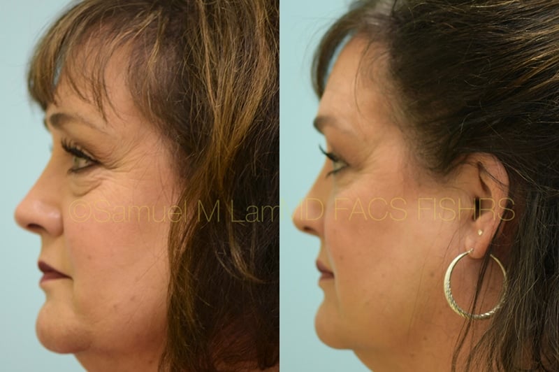 Eyelid Rejuvenation, Fat Grafting Eyelid Rejuvenation, Fat Grafting