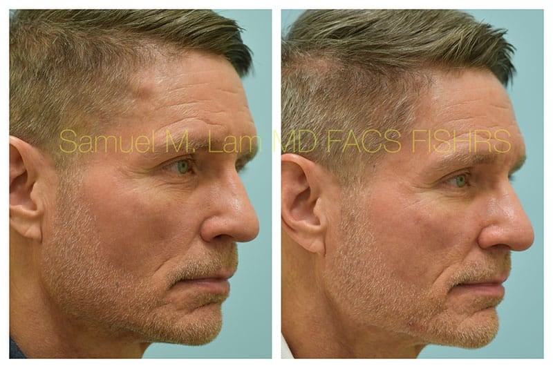 Osteoma Before and After Photo by Dr Lam in Plano TX Osteoma Before and After Photo by Dr Lam in Plano TX