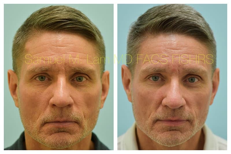 Osteoma Before and After Photo by Dr Lam in Plano TX Osteoma Before and After Photo by Dr Lam in Plano TX