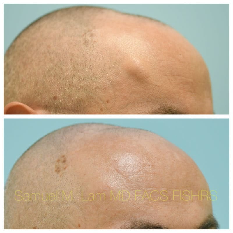 Osteoma Before and After Photo by Dr Lam in Plano TX Osteoma Before and After Photo by Dr Lam in Plano TX
