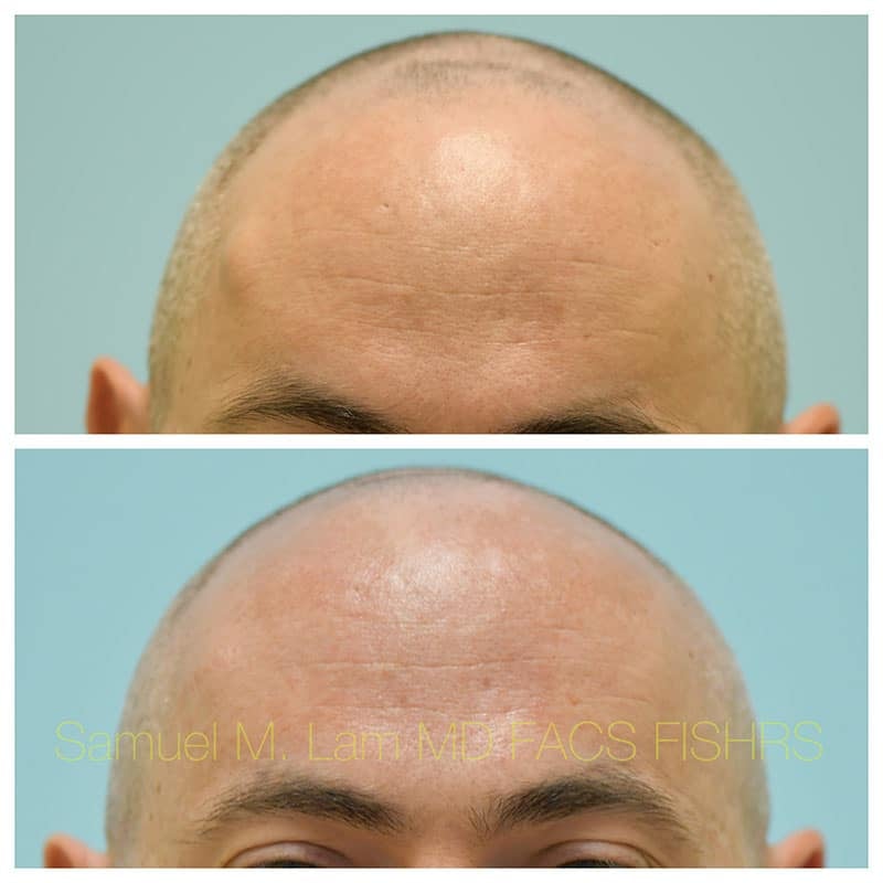 Osteoma Before and After Photo by Dr Lam in Plano TX Osteoma Before and After Photo by Dr Lam in Plano TX