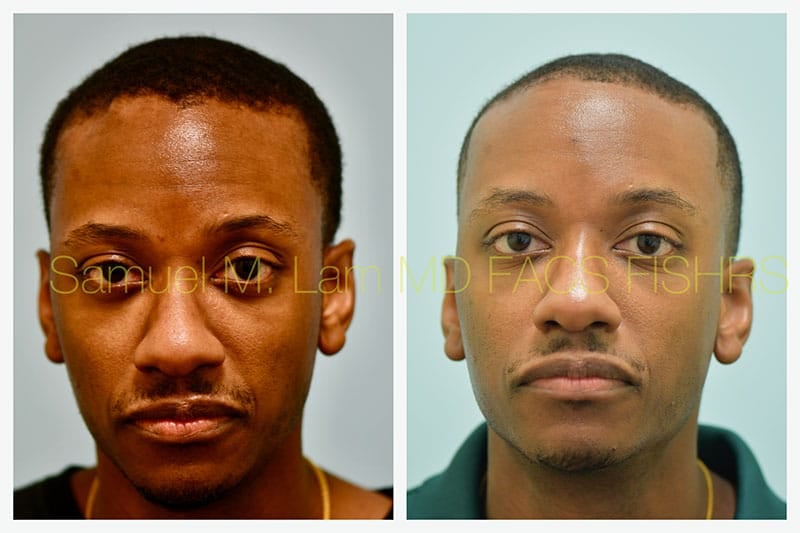 Osteoma Before and After Photo by Dr Lam in Plano TX Osteoma Before and After Photo by Dr Lam in Plano TX