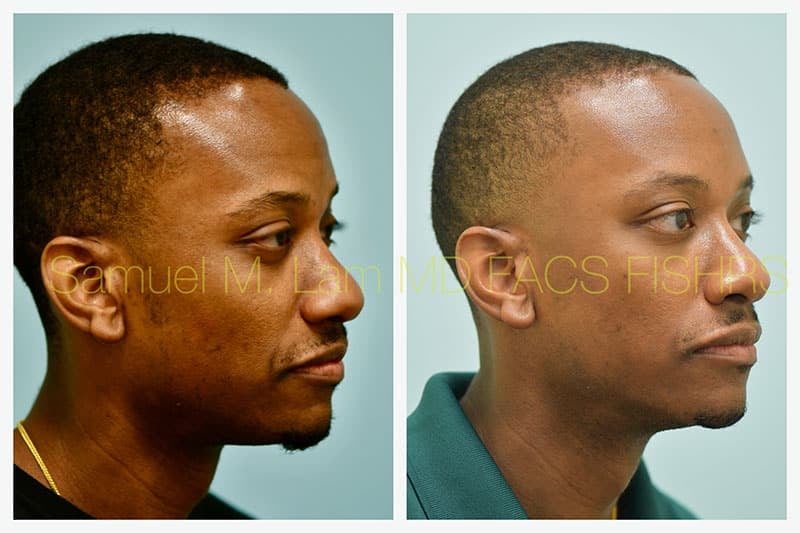 Osteoma Before and After Photo by Dr Lam in Plano TX Osteoma Before and After Photo by Dr Lam in Plano TX