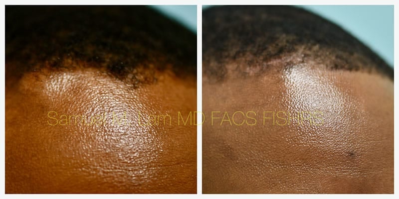 Osteoma Before and After Photo by Dr Lam in Plano TX Osteoma Before and After Photo by Dr Lam in Plano TX