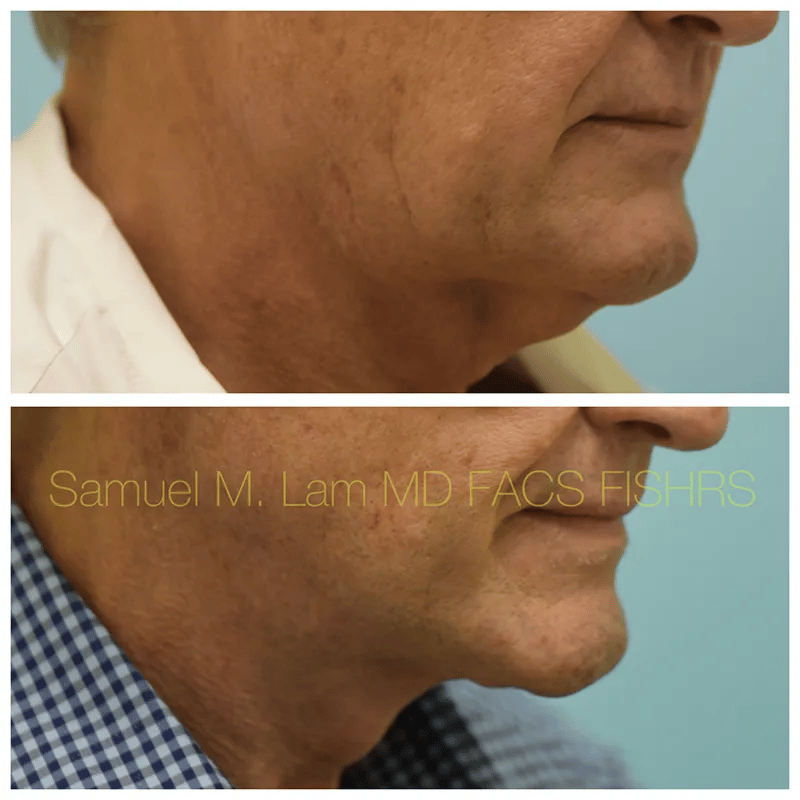 Facelift Before and After Photo by Dr. Lam in Plano TX
