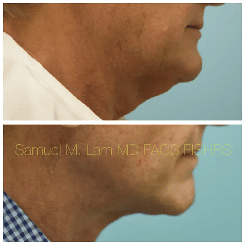 Facelift Before and After Photo by Dr. Lam in Plano TX