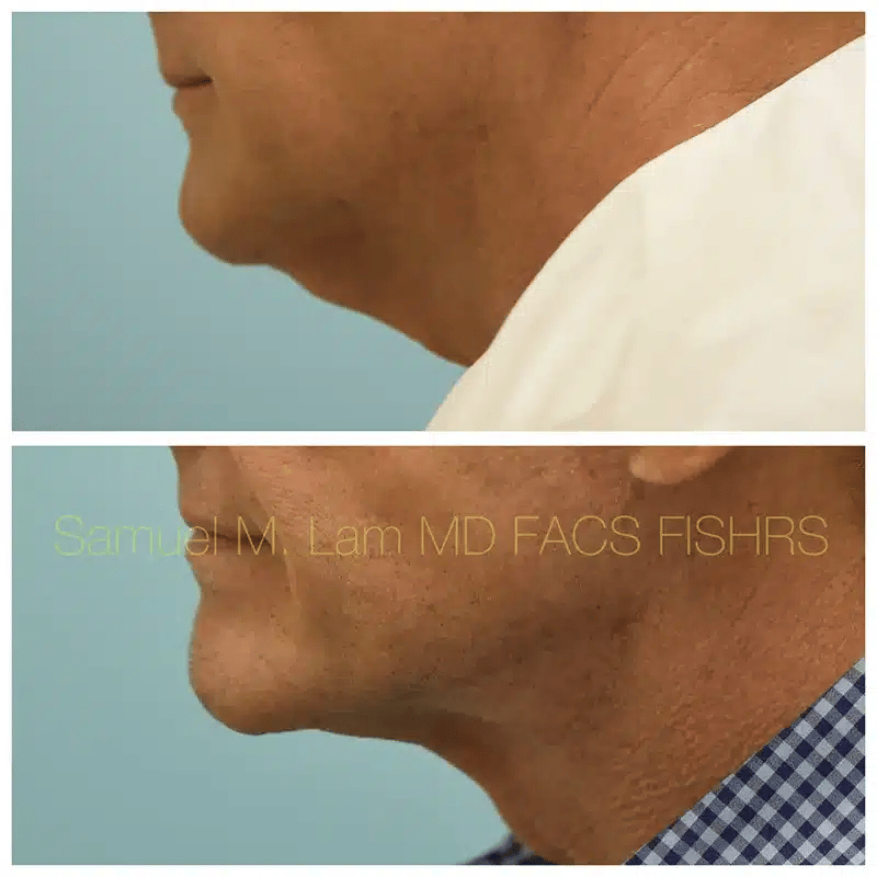 Facelift Before and After Photo by Dr. Lam in Plano TX