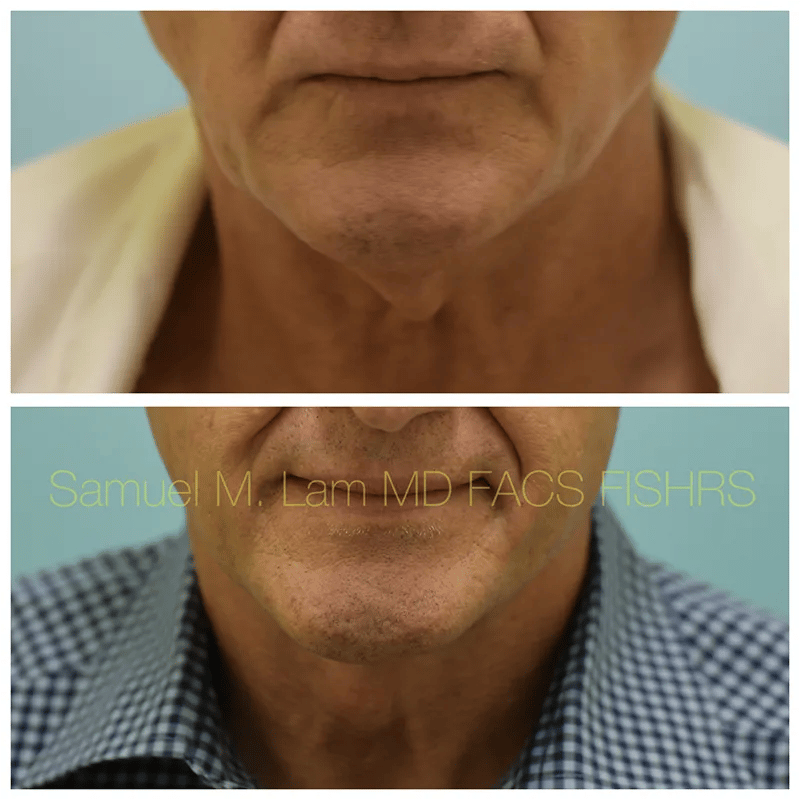 Facelift Before and After Photo by Dr. Lam in Plano TX