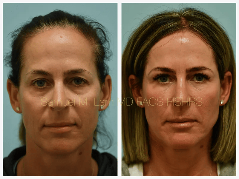 Eyelid Blepharoplasty Before and After Photo by Dr. Lam in Plano TX Eyelid Blepharoplasty Before and After Photo by Dr. Lam in Plano TX
