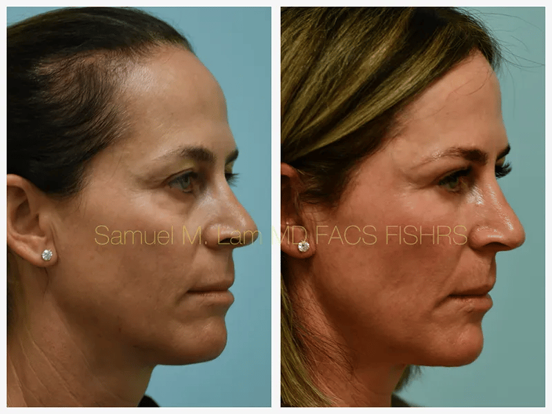 Eyelid Blepharoplasty Before and After Photo by Dr. Lam in Plano TX Eyelid Blepharoplasty Before and After Photo by Dr. Lam in Plano TX