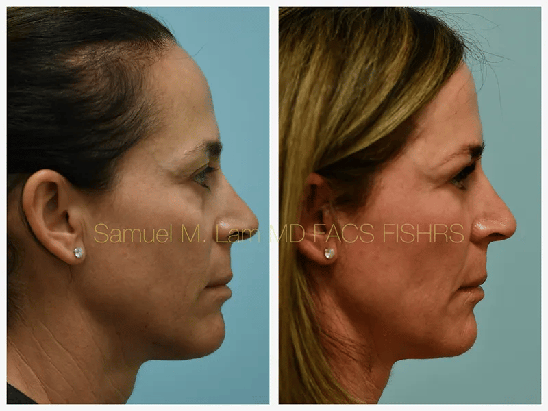Eyelid Blepharoplasty Before and After Photo by Dr. Lam in Plano TX Eyelid Blepharoplasty Before and After Photo by Dr. Lam in Plano TX