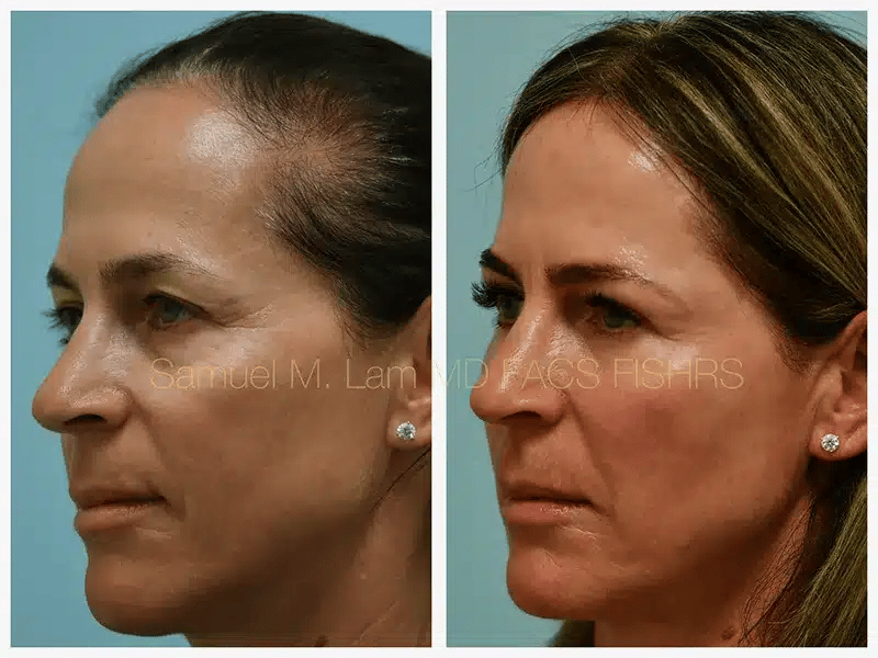 Eyelid Blepharoplasty Before and After Photo by Dr. Lam in Plano TX Eyelid Blepharoplasty Before and After Photo by Dr. Lam in Plano TX