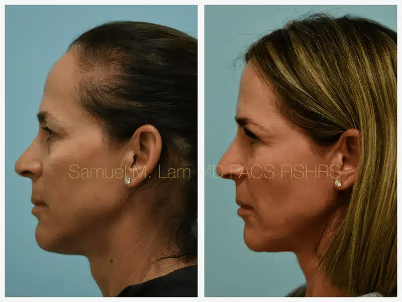 Eyelid Blepharoplasty Before and After Photo by Dr. Lam in Plano TX Eyelid Blepharoplasty Before and After Photo by Dr. Lam in Plano TX
