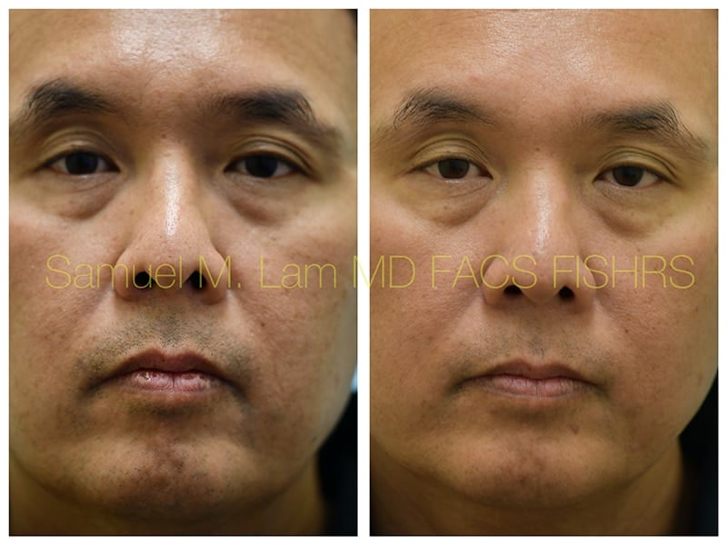MesoBotox Before and After Photo by Dr. Lam in Plano TX MesoBotox Before and After Photo by Dr. Lam in Plano TX