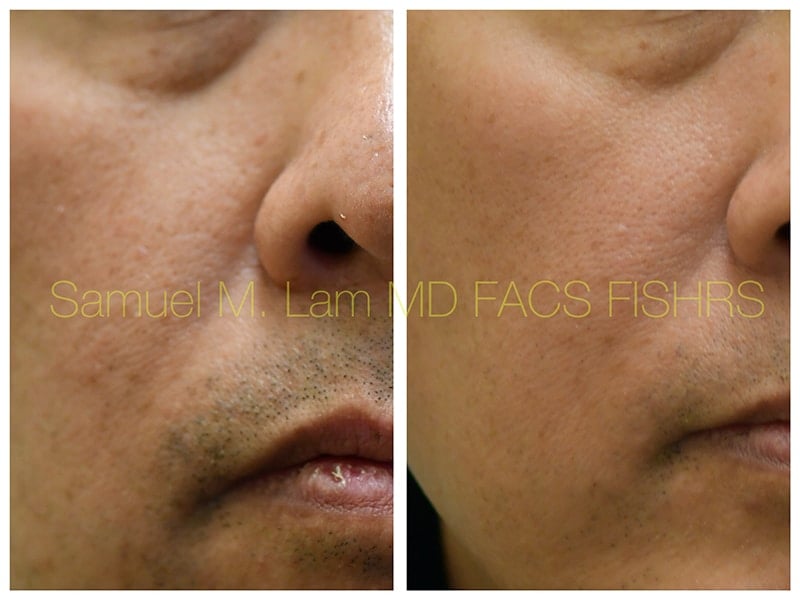 MesoBotox Before and After Photo by Dr. Lam in Plano TX MesoBotox Before and After Photo by Dr. Lam in Plano TX
