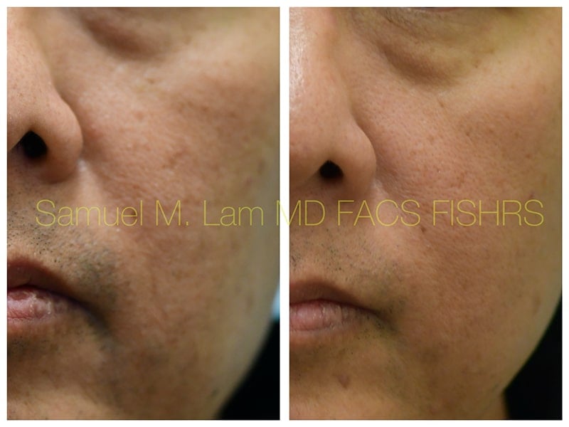 MesoBotox Before and After Photo by Dr. Lam in Plano TX MesoBotox Before and After Photo by Dr. Lam in Plano TX
