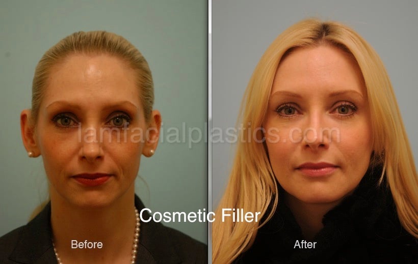 before and after fillers before and after fillers