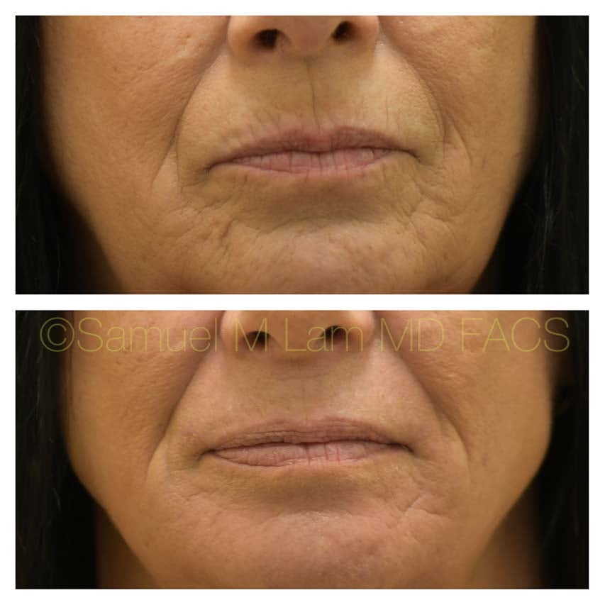 laser treatments of