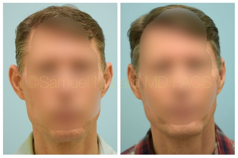 otoplasty of