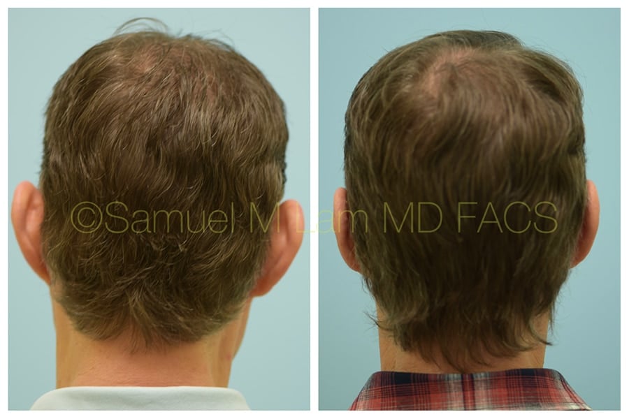 otoplasty of