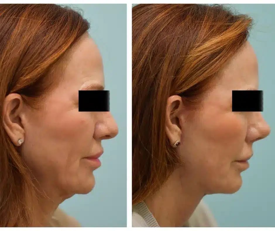 Facelift Before and After Photo by Dr. Lam in Plano TX