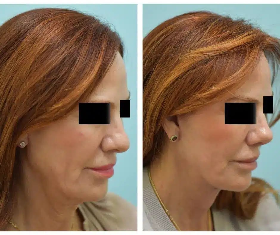 Facelift Before and After Photo by Dr. Lam in Plano TX