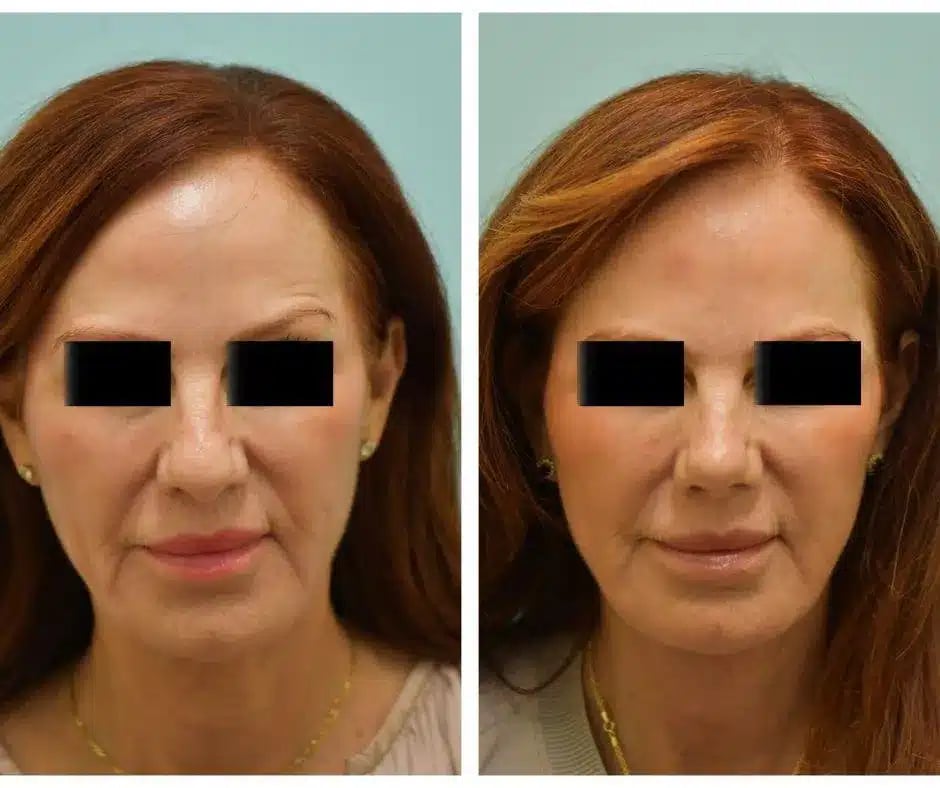 Facelift Before and After Photo by Dr. Lam in Plano TX