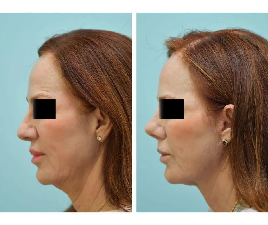 Facelift Before and After Photo by Dr. Lam in Plano TX