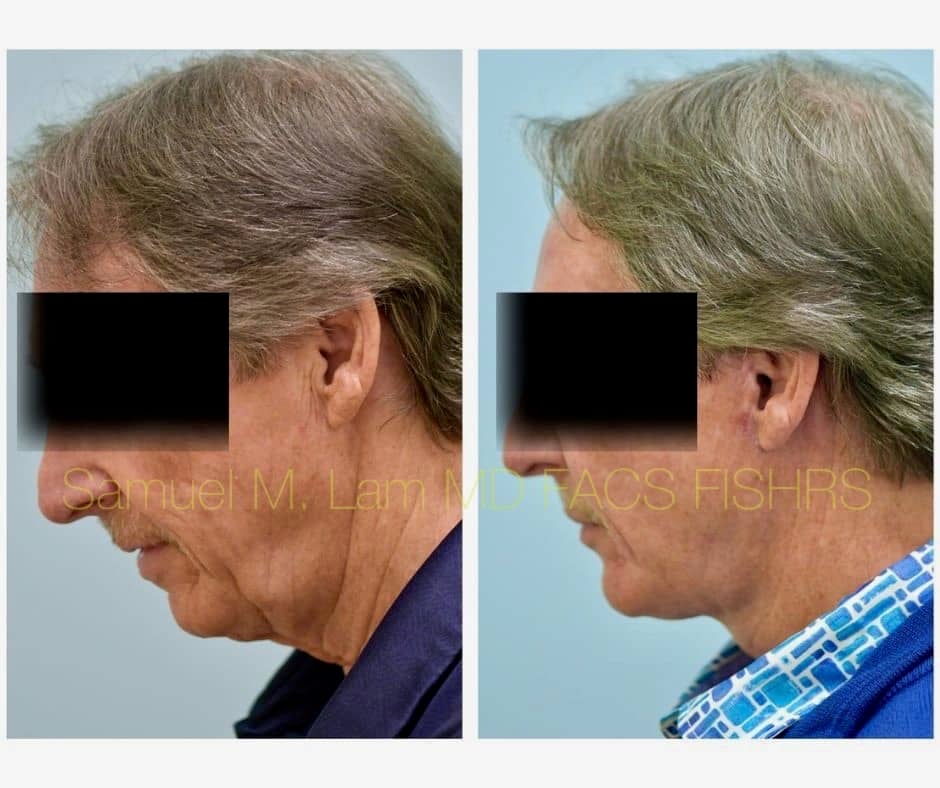 Facelift and Chin Implant Before and After Photo by Dr. Lam in Plano TX