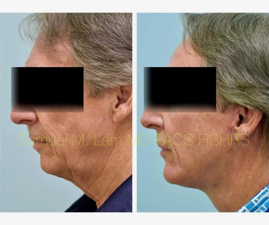 Facelift and Chin Implant Before and After Photo by Dr. Lam in Plano TX