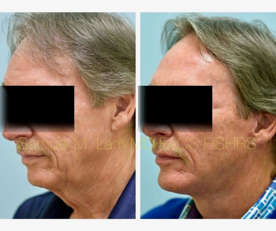 Facelift and Chin Implant Before and After Photo by Dr. Lam in Plano TX