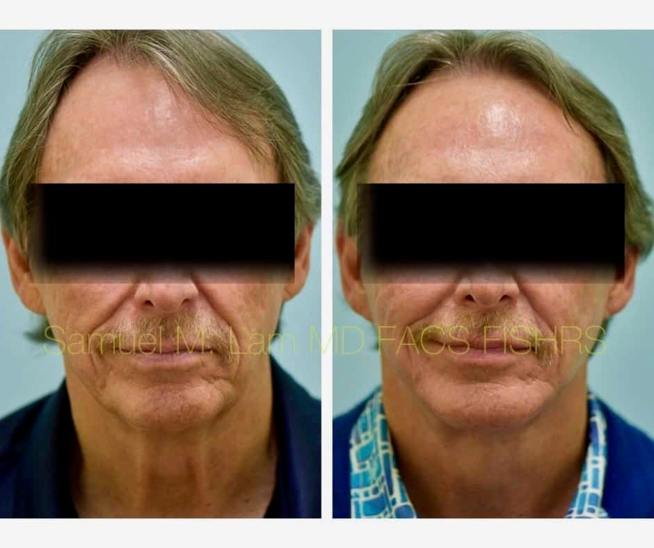Facelift and Chin Implant Before and After Photo by Dr. Lam in Plano TX