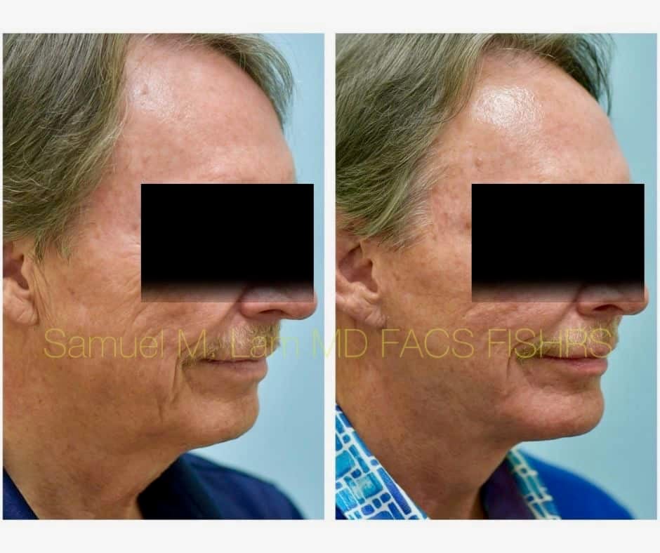 Facelift and Chin Implant Before and After Photo by Dr. Lam in Plano TX