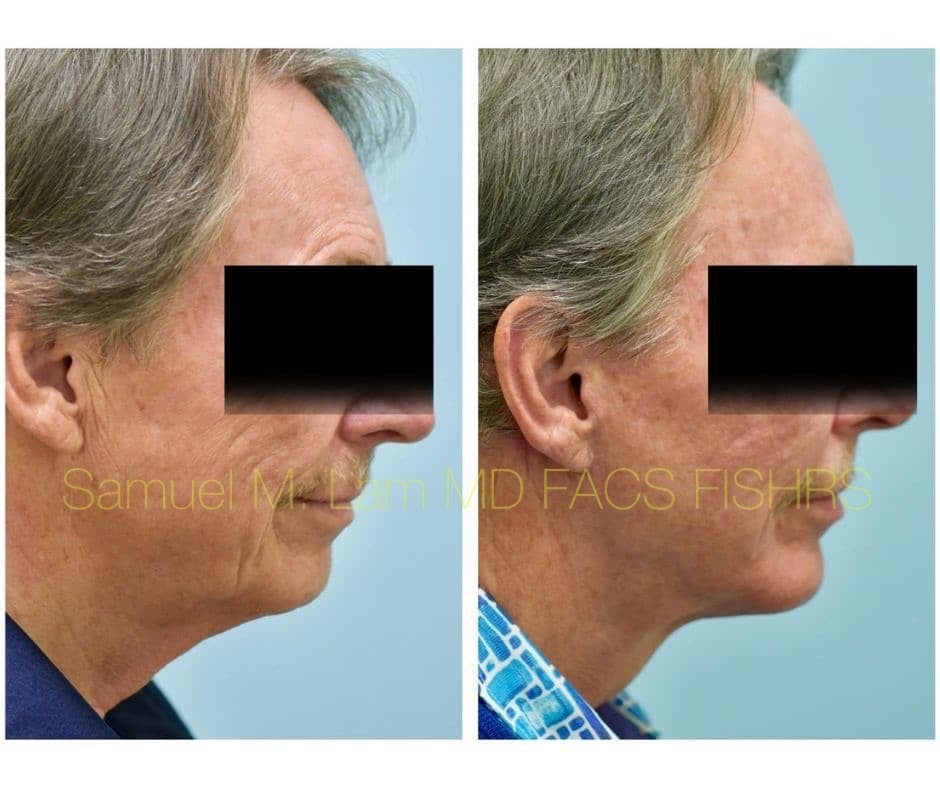 Facelift and Chin Implant Before and After Photo by Dr. Lam in Plano TX