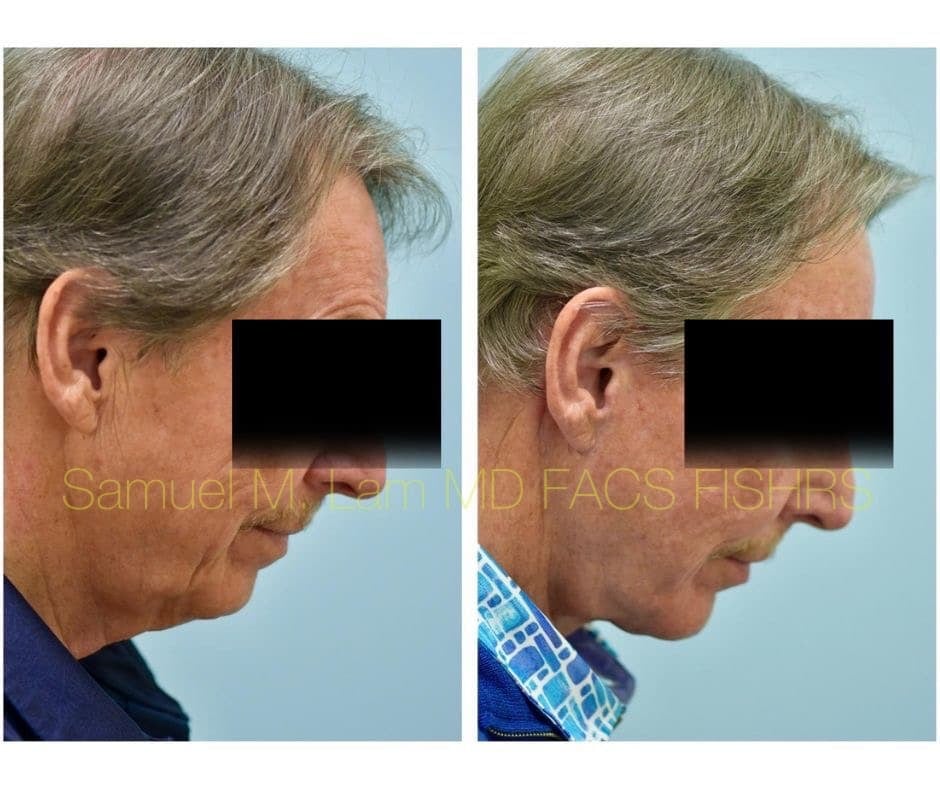 Facelift and Chin Implant Before and After Photo by Dr. Lam in Plano TX
